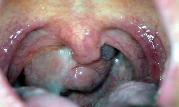 SCAN_COPY_OF_MY_BREAST_CANCER.JPG