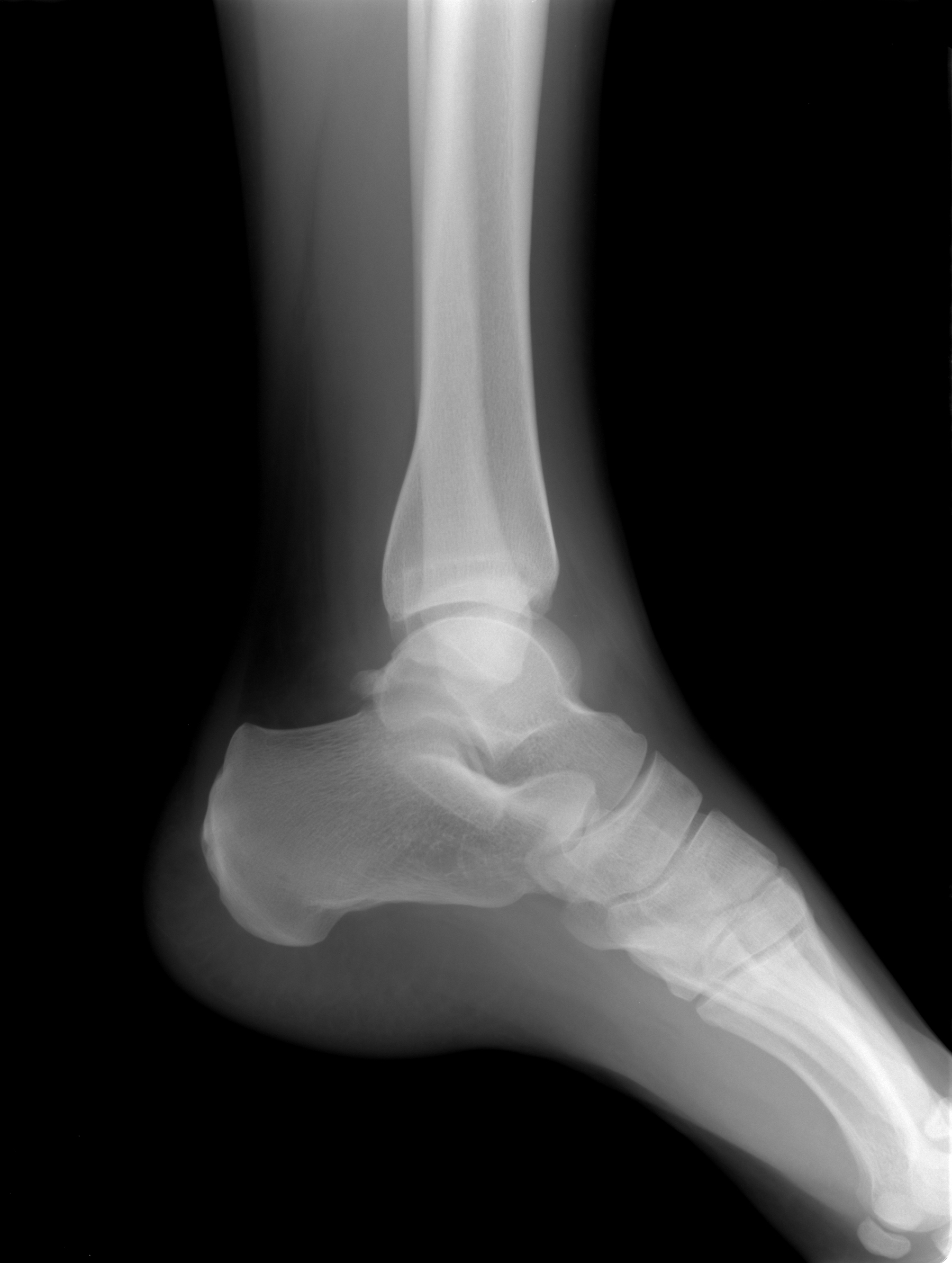 ankle-x-ray.jpg